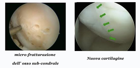 lesioni della cartilagine Roma
